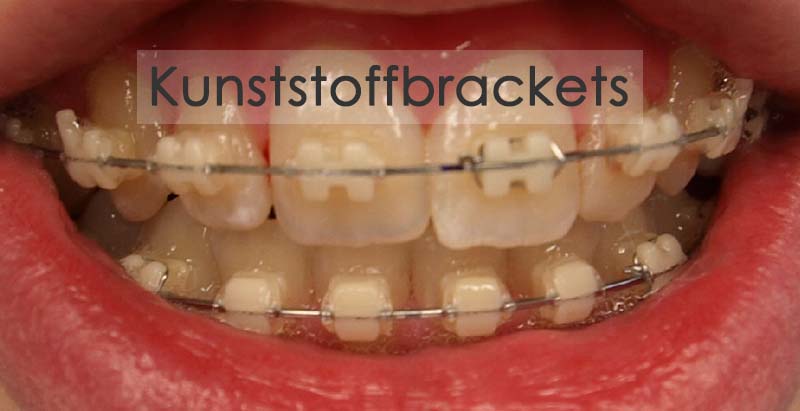 Kunststoffbracket