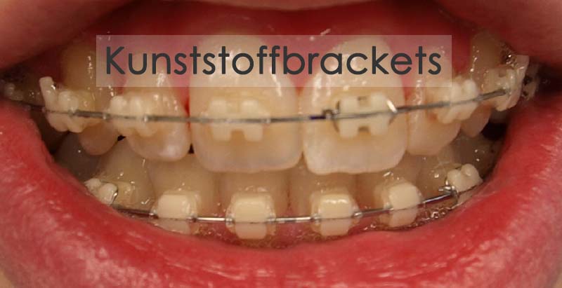 Kunststoffbracket